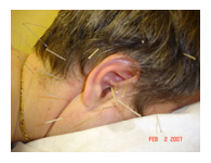acupuncture houston tx