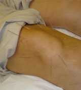 arthritis acupuncture houston