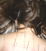 back pain acupuncture houston