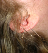 ear acupuncture