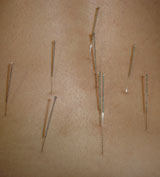 acupuncture houston tx