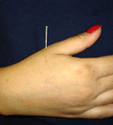 stroke acupuncture houston