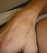 tendonitis acupuncture houston